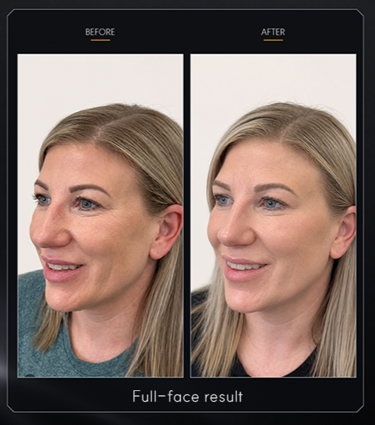 Full-face before-and-after photographs for NEXCELL BOTA