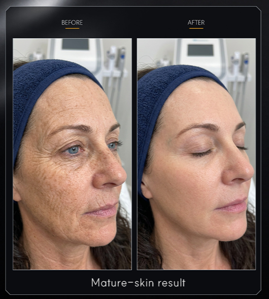 Mature-skin before-and-after photographs for NEXCELL BOTA