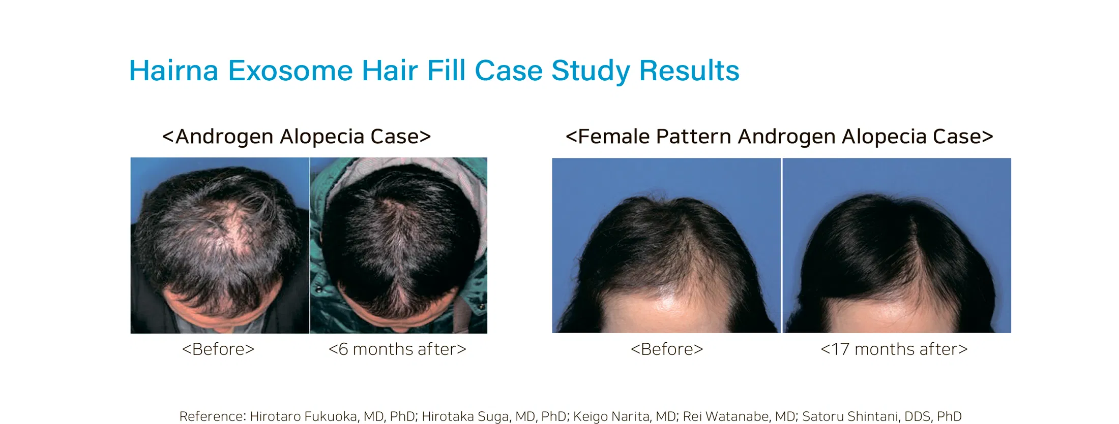 HAIRNA Exosome Hair Fill · product information